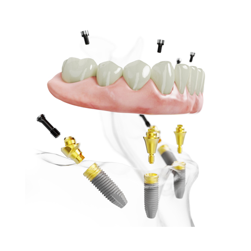 All-on-4 implantáció