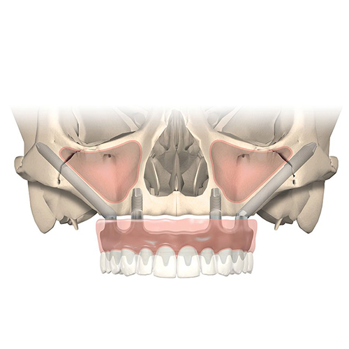 Zygoma implantáció